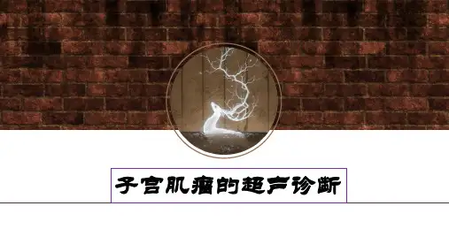 子宫肌瘤超声诊断