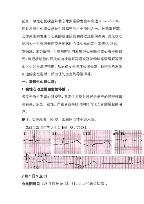 心肌梗死伴有各种心律失常的表现
