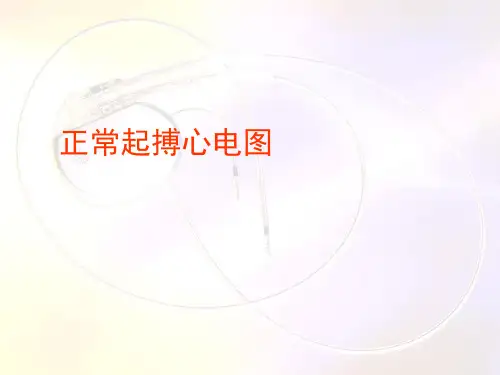 起搏器心电图的解读