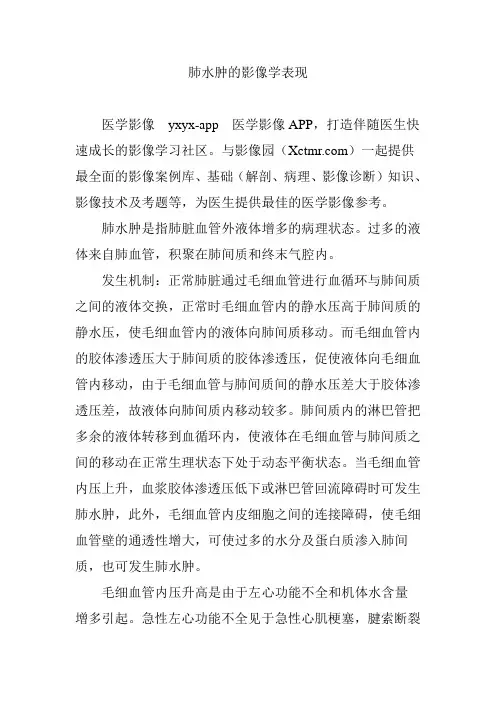 肺水肿的影像学表现 2