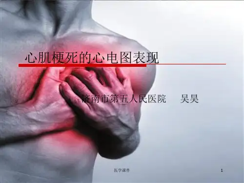 《心肌梗死的心电图表现》 PPT课件