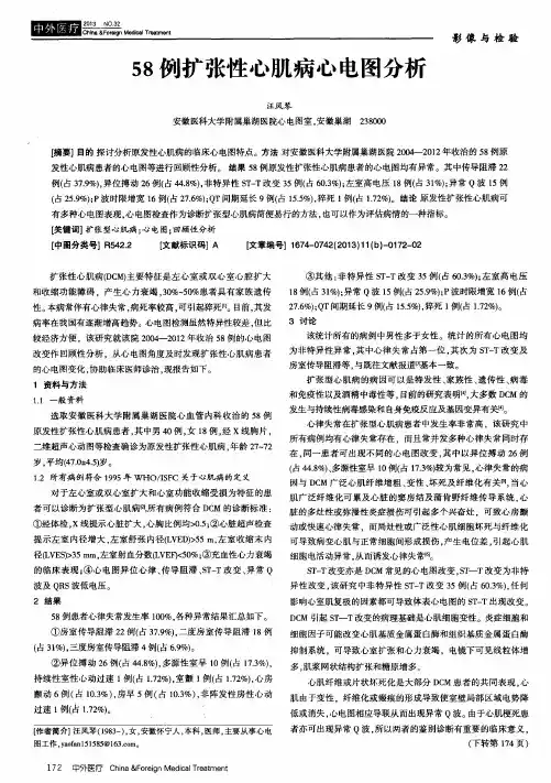 58例扩张性心肌病心电图分析