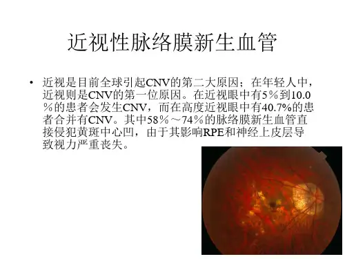 高度近视黄斑新生血管改