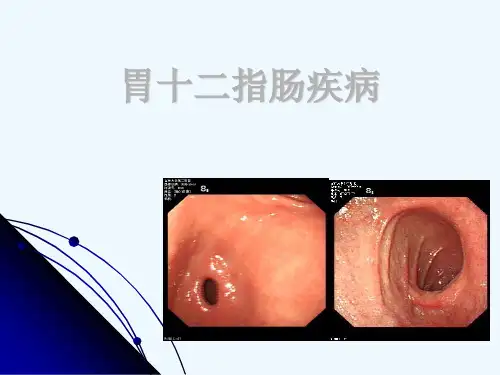 胃十二指肠疾病的内窥镜诊断