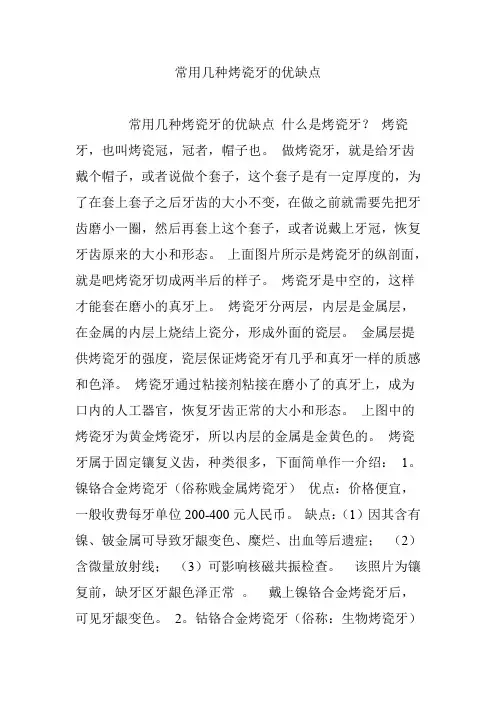 常用几种烤瓷牙的优缺点