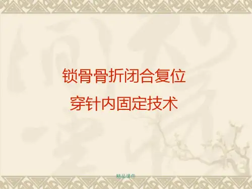锁骨骨折闭合穿针术