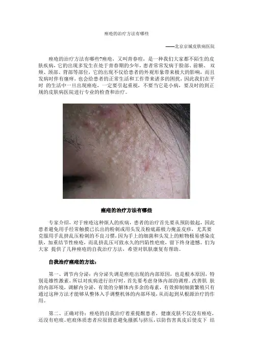 痤疮的治疗方法有哪些