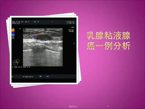 乳腺粘液腺癌一例原件PPT参考幻灯片