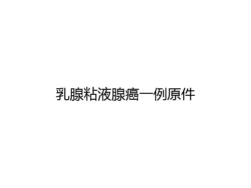 乳腺粘液腺癌一例原件