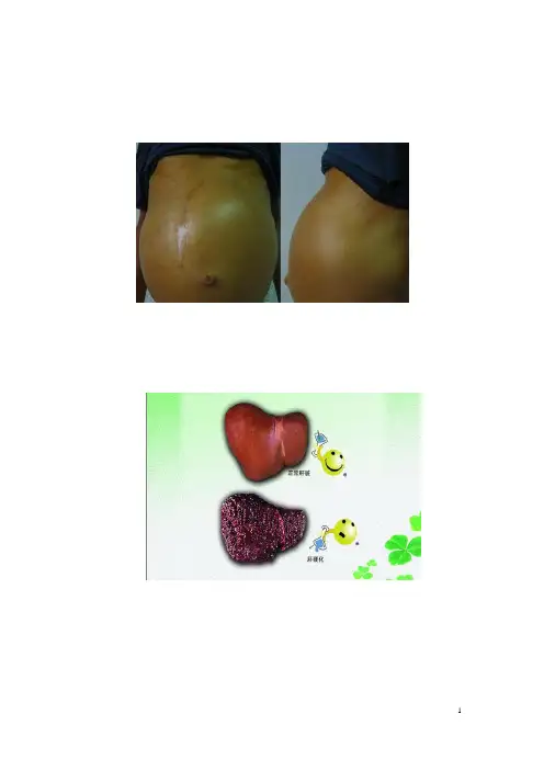 肝硬化健康教育指导(图文)