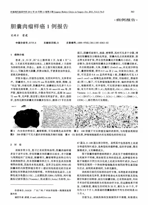 胆囊肉瘤样癌1例报告