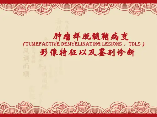 肿瘤样脱髓鞘病变影像特征以及鉴别诊断  ppt课件