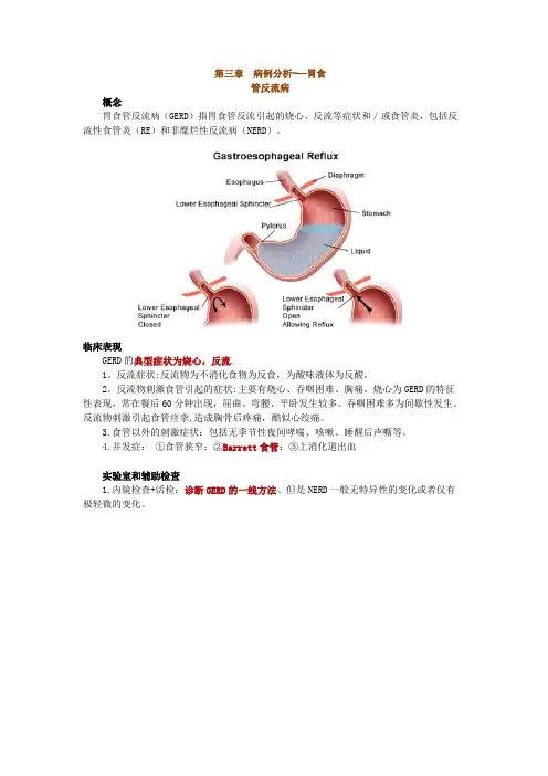 病例分析——胃食管反流病