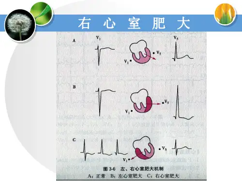 右心室肥大