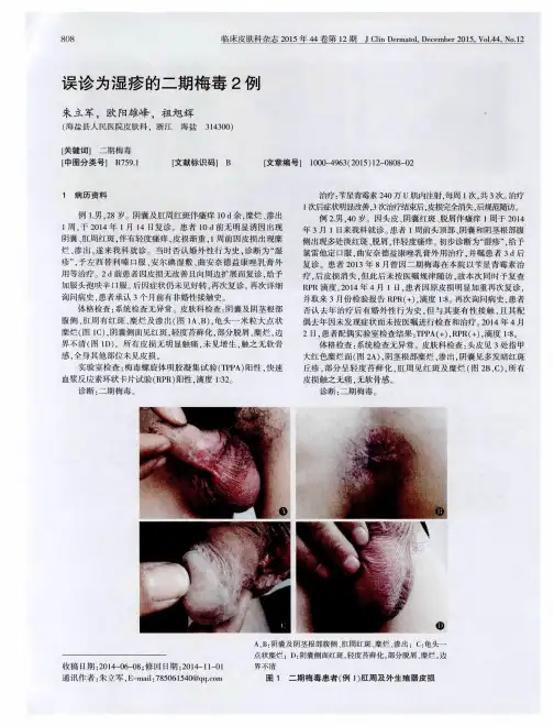 误诊为湿疹的二期梅毒2例
