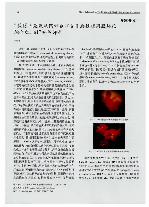 “获得性免疫缺陷综合征合并急性视网膜坏死综合征1例”病例评析