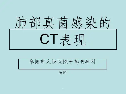 肺部真菌感染的CT表现
