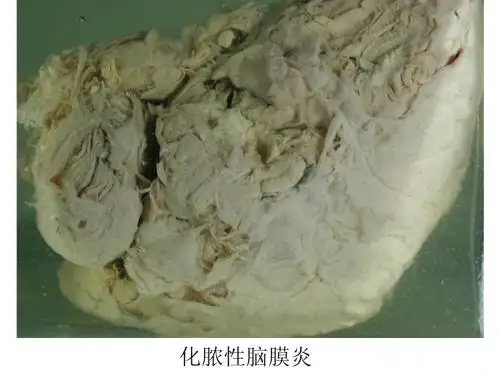 神经系统疾病1