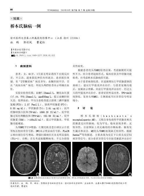 桥本氏脑病一例