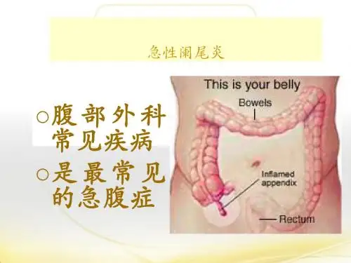 急性阑尾炎  ppt课件