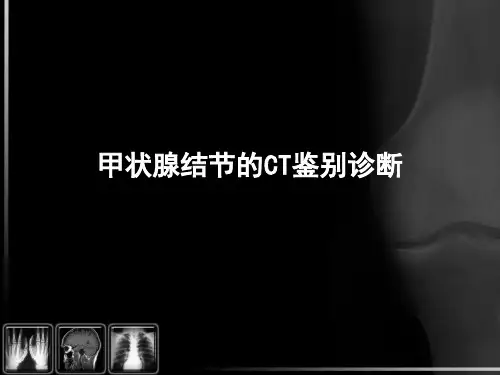 甲状腺结节的CT诊断