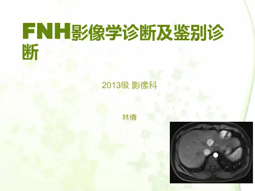 FNH影像学诊断及鉴别诊断
