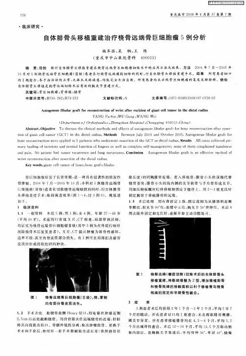 自体腓骨头移植重建治疗桡骨远端骨巨细胞瘤5例分析