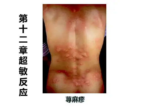 医学免疫学:第十二章 超敏反应