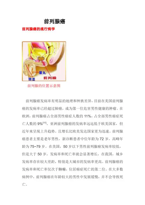 前列腺癌科普文章