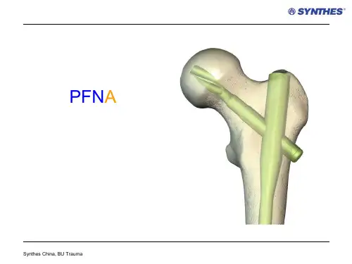 PFNA股骨近端髓内钉