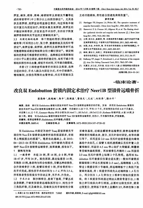 改良双Endobutton套锁内固定术治疗NeerIIB型锁骨远端骨折