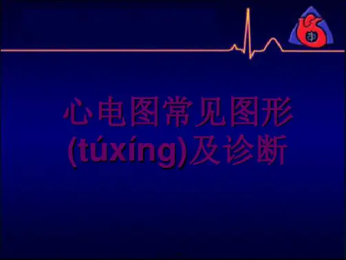 心电图常见波形及诊断