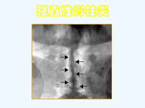 痛风强直性脊柱炎