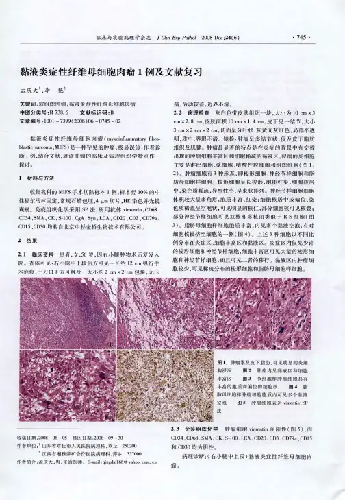 黏液炎症性纤维母细胞肉瘤1例及文献复习