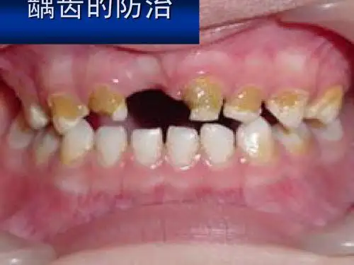 龋齿的防治
