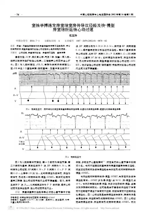 室性早搏诱发房室结室房传导双径路及快_慢型房室结折返性心动过速