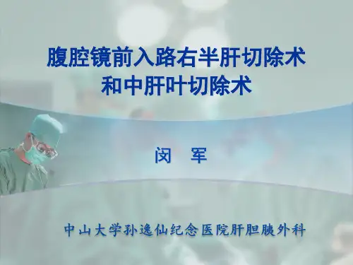 腹腔镜前入路右半肝切除术和中肝叶切除术