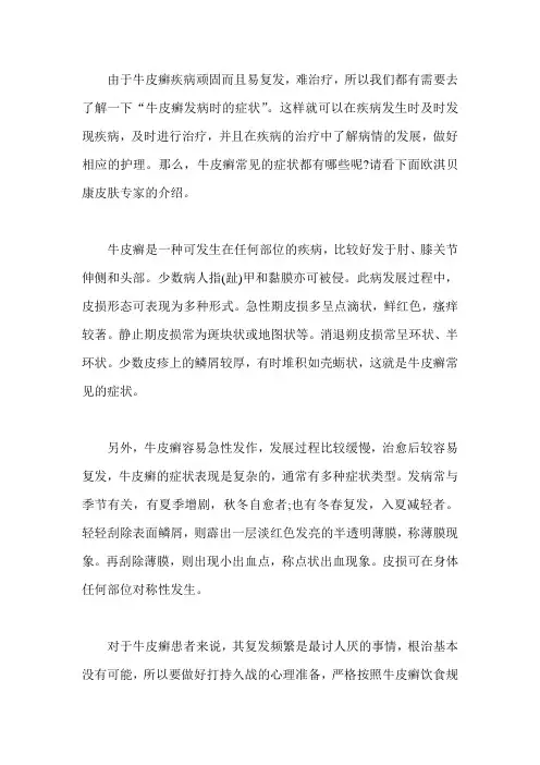 简单介绍一下“牛皮癣常见的症状”