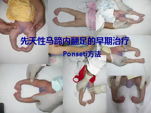 马蹄足