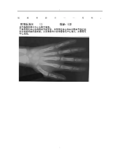 标准骨龄片
