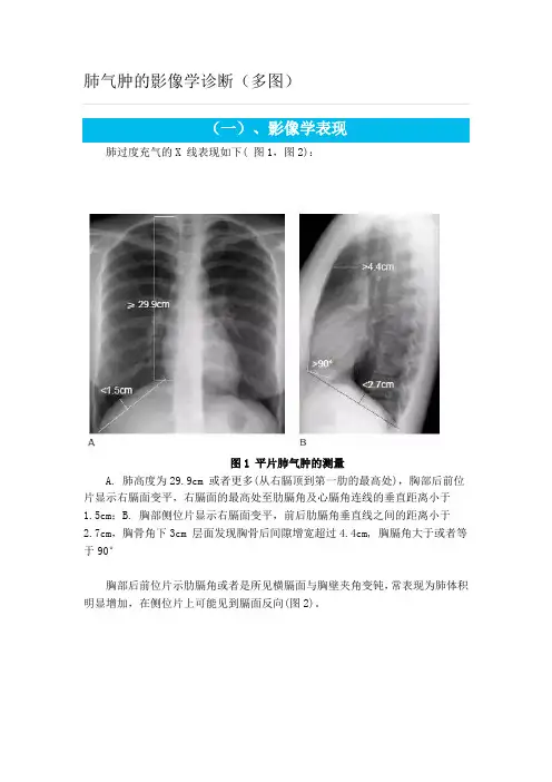 肺气肿的影像学诊断