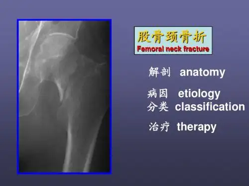 股骨颈骨折 第八版课件