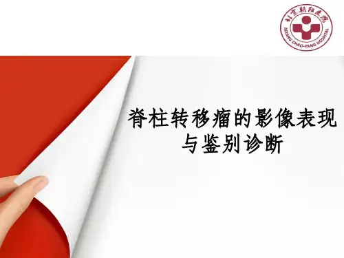 脊柱转移瘤的影像表现与鉴别诊断PPT课件