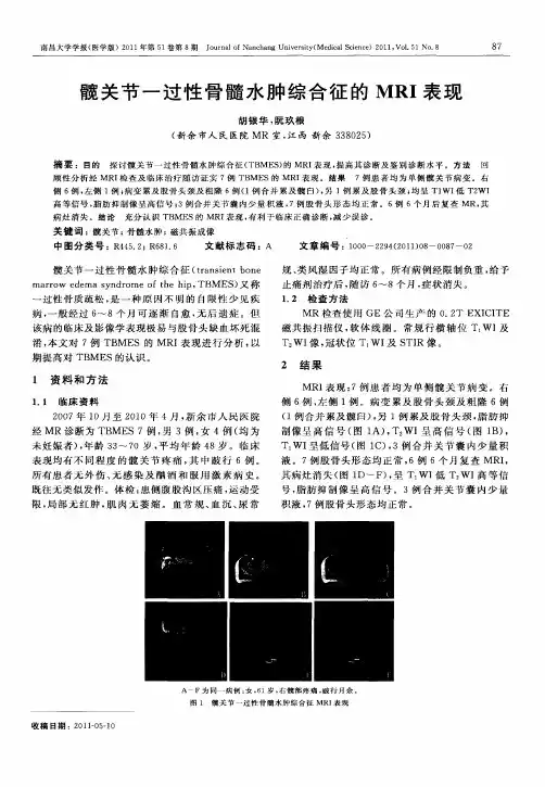 髋关节一过性骨髓水肿综合征的MRI表现