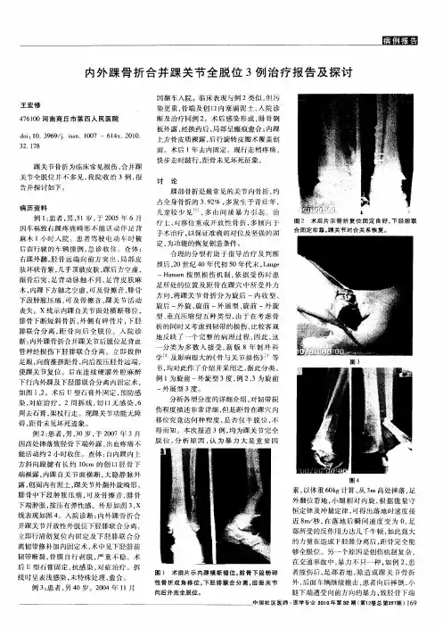 内外踝骨折合并踝关节全脱位3例治疗报告及探讨
