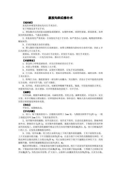 腹股沟斜疝修补术