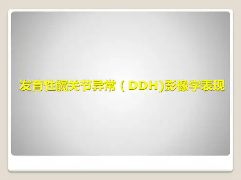 发育性髋关节异常影像学表现