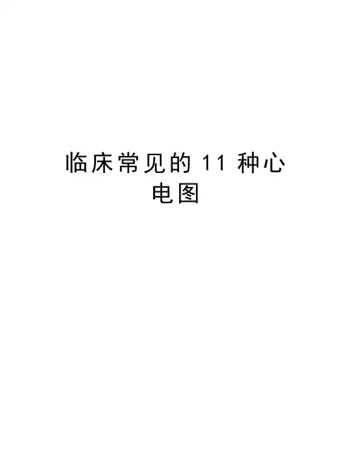 临床常见的11种心电图