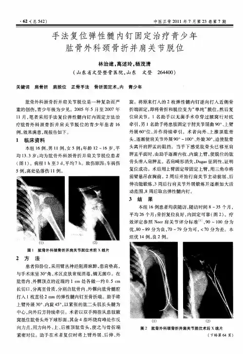 手法复位弹性髓内钉固定治疗青少年肱骨外科颈骨折并肩关节脱位