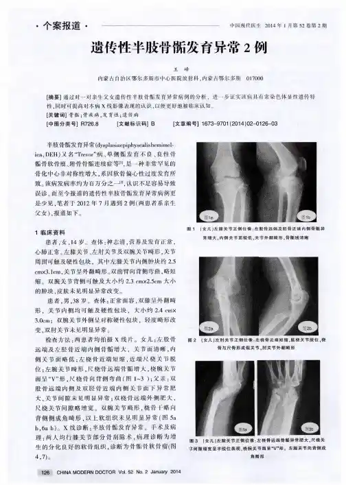 遗传性半肢骨骺发育异常2例